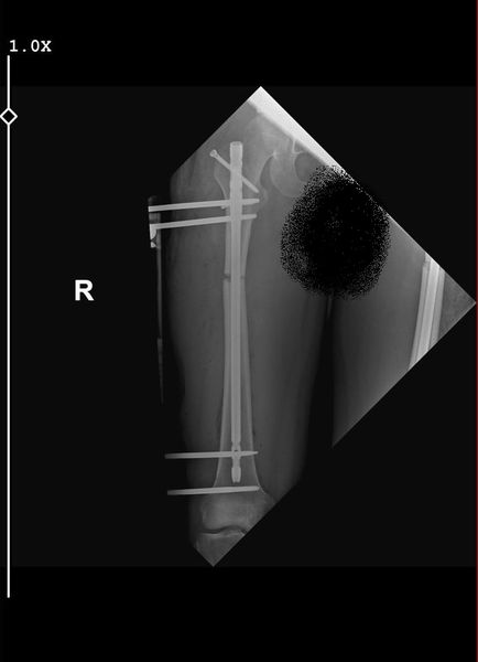 Lon Femur Surgery 167 cm start height ( My doc is professor Halil İbrahim Balci)