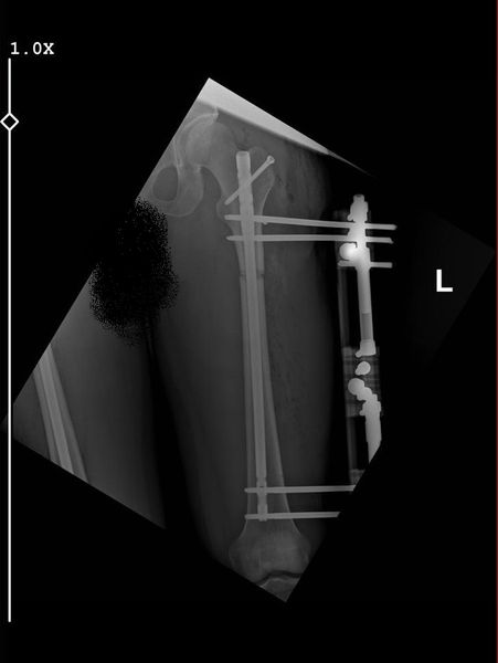 Lon Femur Surgery 167 cm start height ( My doc is professor Halil İbrahim Balci)